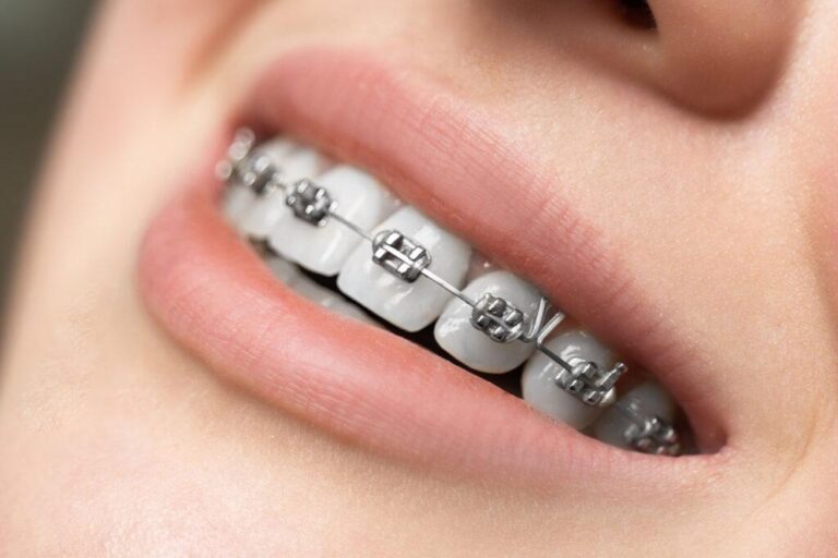 Metal Braces